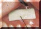 Topicale Gelpatch